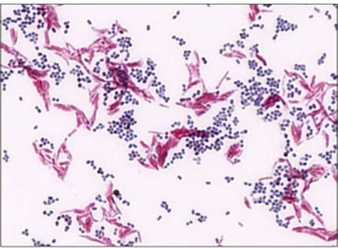 Sample of Acid-Fast Staining | Red - Acid-Fast Bacilli (AFB ...