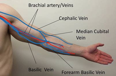 Brachiobasilic Arteriovenous Fistula | SpringerLink