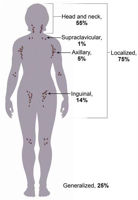 Lymphadenopathy - Cancer Therapy Advisor