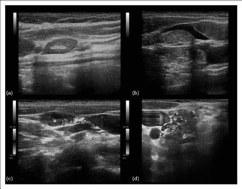 Lymphoma Neck Ultrasound