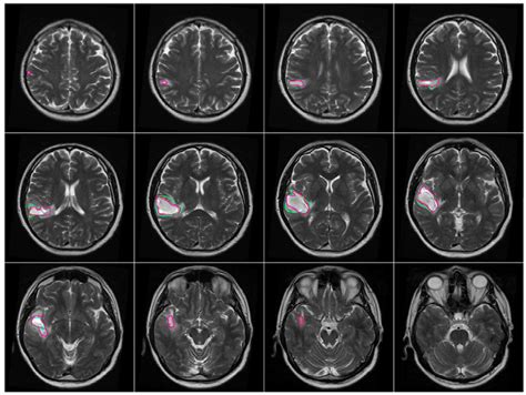 Brain Mri Scan Tumor