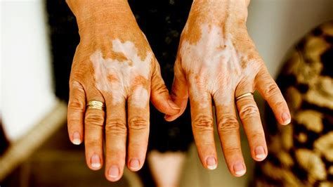 Vitiligo: Types, Causes, and Who Gets It | Everyday Health