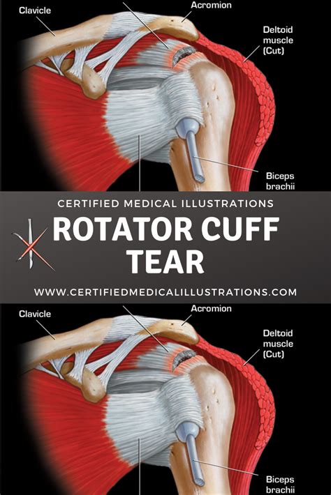 Left Shoulder Rotator Cuff Anatomy