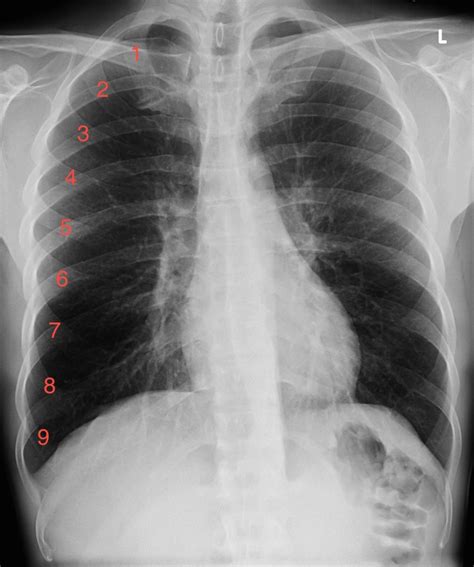 Emphysema - Radiology at St. Vincent's University Hospital