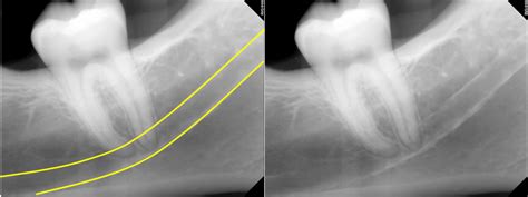 Anatomy Monday: Anatomy on Mandibular Periapical Radiographs – Dr. G's ...