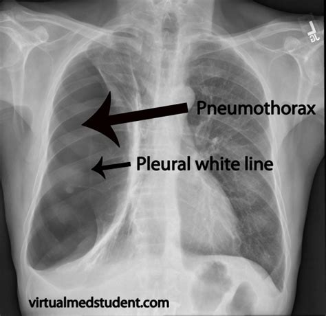 Pneumothorax - Physiopedia