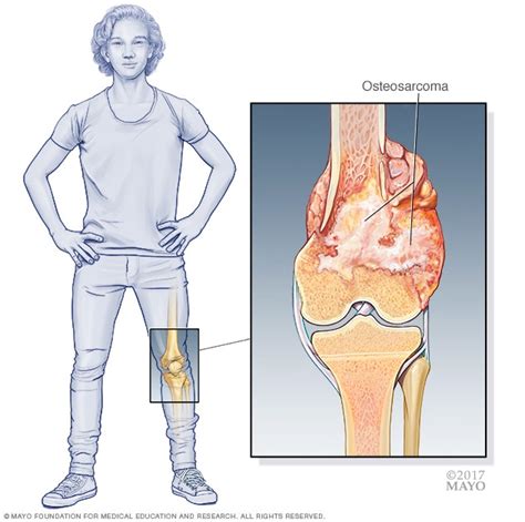 Bone Cancer: Causes, Symptoms & Treatments | Global Treatment Services ...