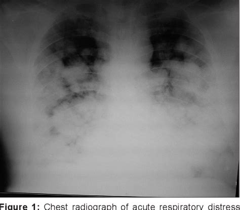 Figure 1 from Management of refractory hypoxemia | Semantic Scholar