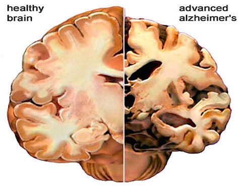 Científicos rusos dan a conocer posible cura del Alzheimer y Parkinson ...