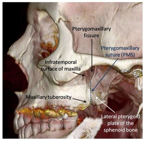 Pterygoid Plate Fracture