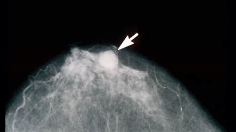 False positive mammogram is real risk factor for breast cancer, study ...