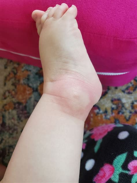 Huge mosquito bite.. Cause for concern or normal reaction? | BabyCenter