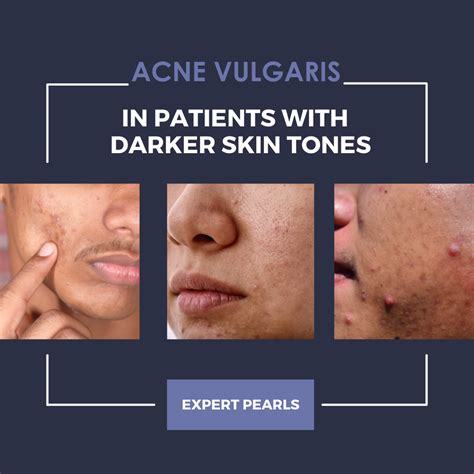 Acne Vulgaris: Nuances in the Approach to Treatment in Patients with ...