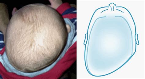 Plagiocephaly vs Brachycephaly | The Key Differences