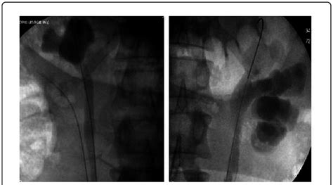 Intra-operative retrograde pyelogram showing the patient's upper ...