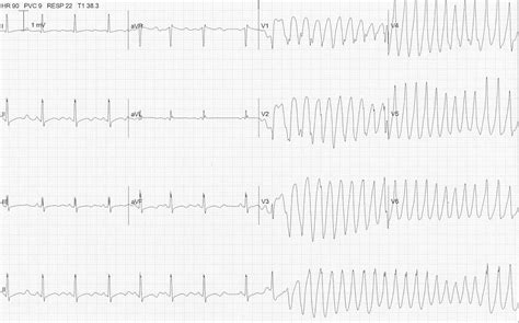 Hypokalemia Ecg Strip