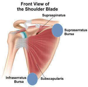 Scapulothoracic Bursitis aka Snapping Scapula Syndrome