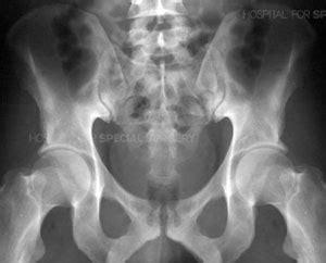 Pelvic Fractures/Acetabular Fractures