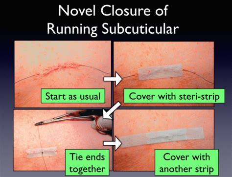 Subcuticular Suturing Pearls – Closing the Gap