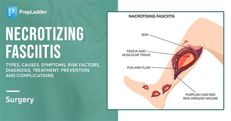 Necrotizing Fasciitis: Types, Causes, Symptoms, Risk Factors, Diagnosis ...