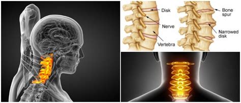 Cervical Spondylosis: Causes, Symptoms and Treatment - Hoool Health ...