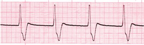 Accelerated Idioventricular Rhythm - EKG Lesson #315