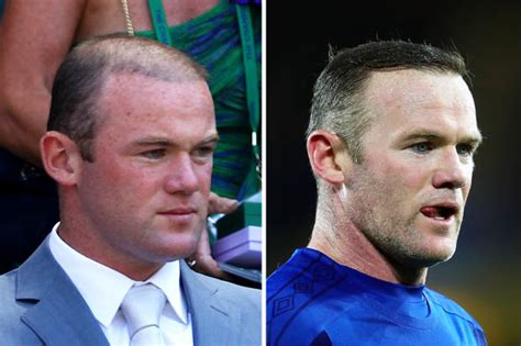 Wayne-Rooney-hair-transplant-before-and-after - Celebrities hair ...