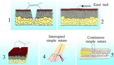 Surgical suture, types of sutures, sizes, how to suture & suture ...