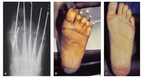 Pan Metatarsal Head Resection | Musculoskeletal Key