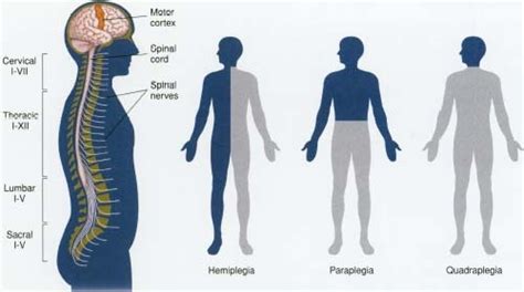 Symptom finder - The causes of hemiplegia - Medical Zone