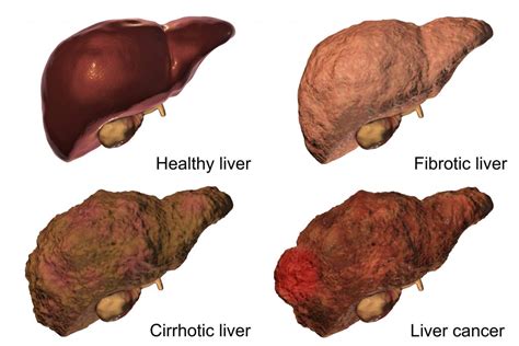 Alcohol and The Liver: Know What Is At Stake - AILBS India