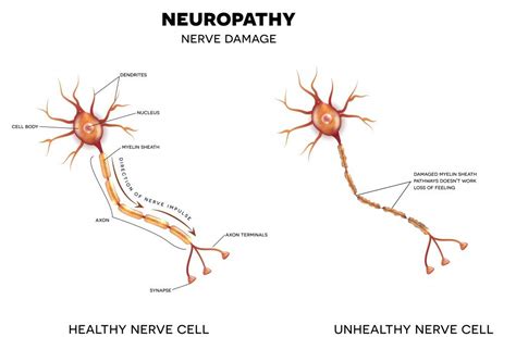 Neuropathy Treatment NJ | All Natural Methods for Pain Relief