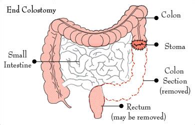 Colostomy - Surgical Procedure