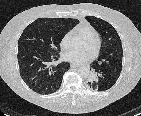 Ultra-low dose CT chest | Radiology SA