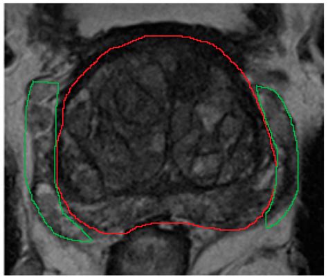 Diagnostics | Free Full-Text | Machine Learning in Prostate MRI for ...