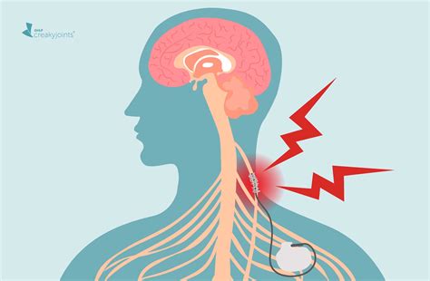 Understanding Neuromodulation and Vagus Nerve Stimulation for ...