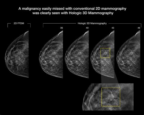 How to Plan Mammography Exams Around COVID-19 Vaccines