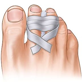 Sprained Toe | Toe Sprain | Symptoms & Treatment | Florida Foot & Ankle