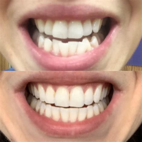 Results after 21 trays! Heading in today for refinements. : r/Invisalign