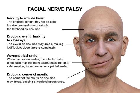 Symptoms of bell's palsy - MEDizzy