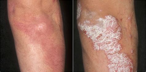 Psoriasis: new treatments, excellent results | MSR News Online