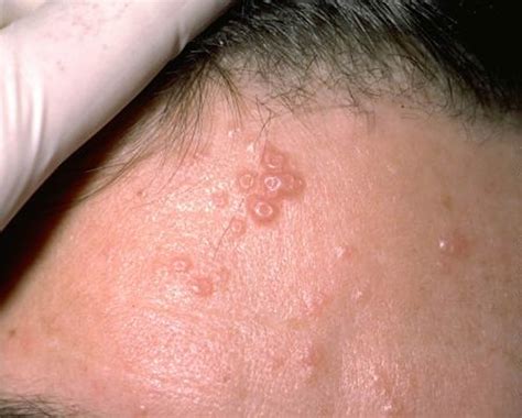 Molluscum Contagiosum Causes, Transmission, Treatment & Prevention