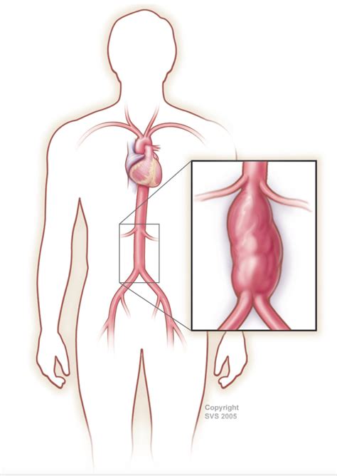 Abdominal aortic aneurysm - Oaklawn Hospital