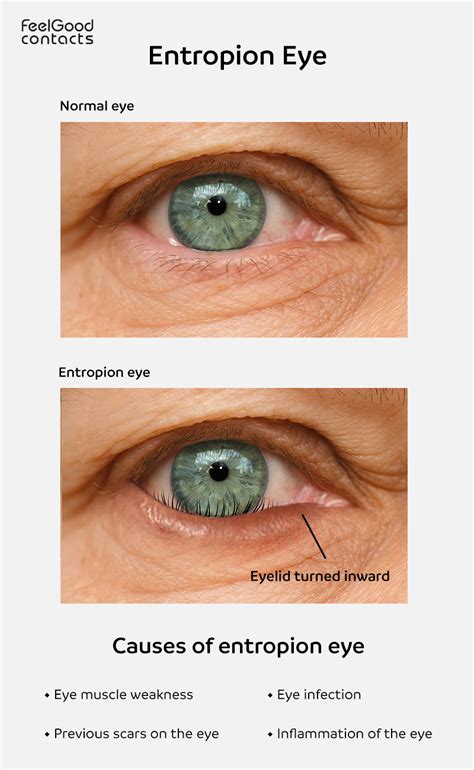 Entropion eye - causes, symptoms & treatments| Feel Good Contacts