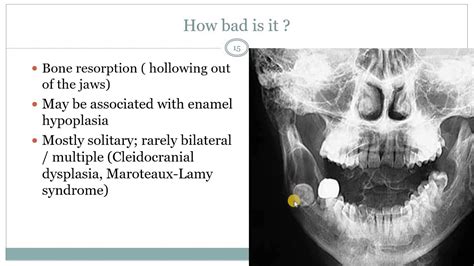 Dentigerous cyst and Eruption cyst - YouTube