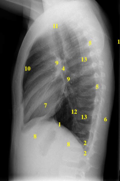 Approach to the Chest X-ray (CXR) – Undergraduate Diagnostic Imaging ...