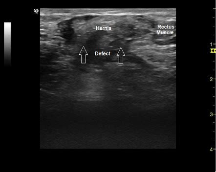 Ventral Hernia Ultrasound