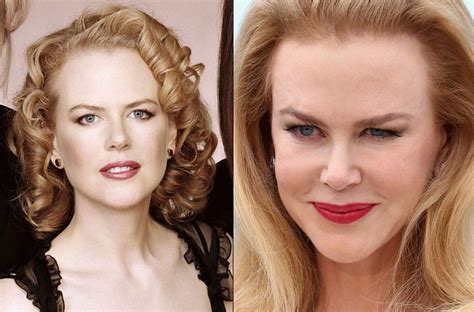 Nicole Kidman before and after plastic surgery (28) | Celebrity plastic ...