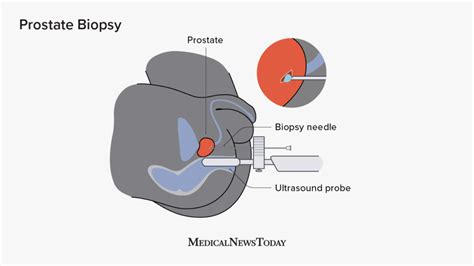 Prostate biopsy: Procedure, preparation, recovery, and results