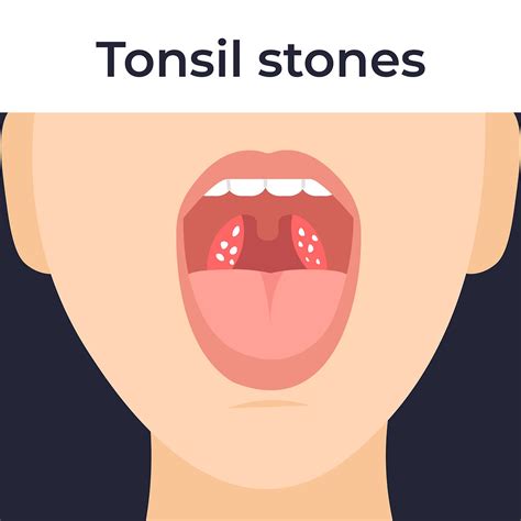 Do You Have Tonsil Stones? Causes, Symptoms & Treatments, With Puyallup ...